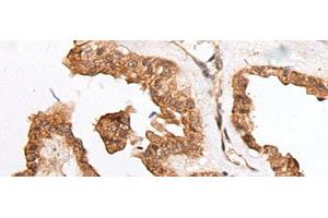 Immunohistochemistry of paraffin-embedded Human thyroid cancer tissue using HOXB9 Polyclonal Antibody at dilution of 1:45(x200) (HOXB9 Antikörper)