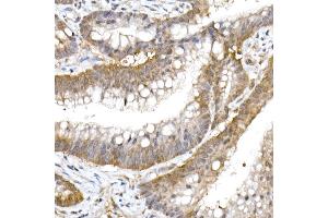 Immunohistochemistry of paraffin-embedded human colon carcinoma using UFM1 Rabbit mAb (ABIN7271183) at dilution of 1:50 (40x lens).
