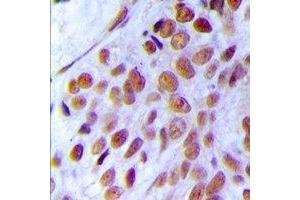 Immunohistochemical analysis of MRE11 staining in human breast cancer formalin fixed paraffin embedded tissue section. (Mre11 Antikörper)