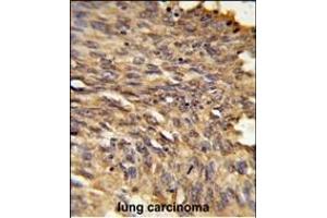 Formalin-fixed and paraffin-embedded human lung carcinoma reacted with HDLBP Antibody (Center), which was peroxidase-conjugated to the secondary antibody, followed by DAB staining.