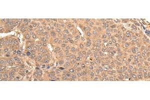 Immunohistochemistry of paraffin-embedded Human liver cancer tissue using BUD31 Polyclonal Antibody at dilution of 1:75(x200) (BUD31 Antikörper)