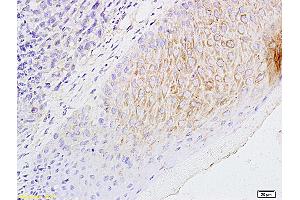 Formalin-fixed and paraffin embedded mouse foot tumor labeled with Anti-CCL21/6CKINE Polyclonal Antibody, Unconjugated (ABIN732698) followed by conjugation to the secondary antibody and DAB staining (CCL21 Antikörper  (AA 24-134))