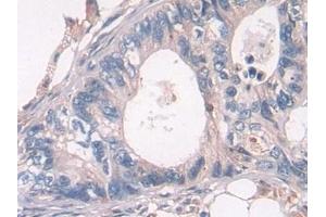 Detection of PSMD2 in Human Colorectal cancer Tissue using Polyclonal Antibody to Proteasome 26S Subunit, Non ATPase 2 (PSMD2)