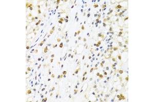 Immunohistochemistry of paraffin-embedded human kidney cancer using SUMO4 Antibody. (SUMO4 Antikörper)