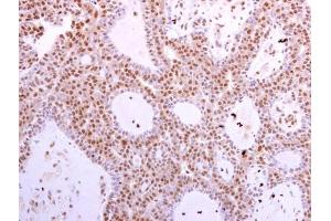 CDK6 antibody [N1C3] detects CDK6 protein at cytoplasm and nucleus in human lung adenocarcinoma by immunohistochemical analysis. (CDK6 Antikörper)