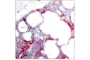 Immunohistochemical analysis of paraffin-embedded human breast carcinoma tissue using ATF2(Phospho-Ser62 or 44) Antibody. (ATF2 Antikörper  (pSer62))