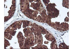 Immunohistochemical staining of paraffin-embedded Human breast tissue using anti-DSTN mouse monoclonal antibody. (Destrin Antikörper)
