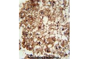 CD11b antibody (N-term) immunohistochemistry analysis in formalin fixed and paraffin embedded human hepatocarcinoma followed by peroxidase conjugation of the secondary antibody and DAB staining. (CD11b Antikörper  (N-Term))