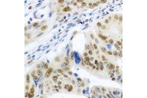 Immunohistochemical analysis of IRF-6 staining in human colon cancer formalin fixed paraffin embedded tissue section. (IRF6 Antikörper)