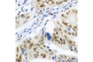 Immunohistochemical analysis of IRF-6 staining in human colon cancer formalin fixed paraffin embedded tissue section.