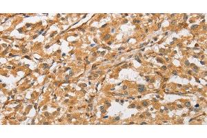 Immunohistochemistry of paraffin-embedded Human thyroid cancer tissue using ARMCX1 Polyclonal Antibody at dilution 1:40 (ARMCX1 Antikörper)