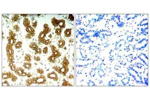 Immunohistochemical analysis of paraffin-embedded human breast carcinoma tissue using Keratin 8 (Ab-73) antibody (E021307). (Cytokeratin 18 Antikörper)
