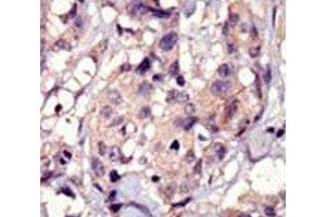 IHC analysis of FFPE human breast carcinoma tissue stained with PDGFRA antibody (PDGFRA Antikörper  (AA 1048-1077))