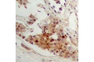 Immunohistochemical analysis of CAR staining in human breast cancer formalin fixed paraffin embedded tissue section.