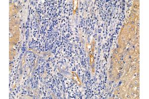 ECM2 Antibody at 1/100 staining Human liver cancer and adjacent normal tissues by IHC-P.