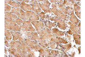 IHC-P Image GSTT1 antibody detects GSTT1 protein at cytosol on human gastric cancer by immunohistochemical analysis.