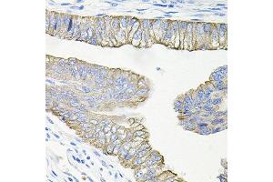 Immunohistochemistry of paraffin-embedded human colon carcinoma using ACVR2A antibody at dilution of 1:100 (x40 lens).