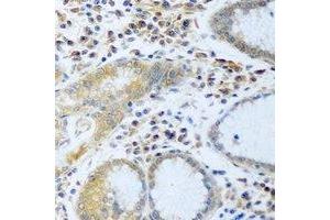 Immunohistochemical analysis of Desmoplakin staining in human stomach cancer formalin fixed paraffin embedded tissue section. (Desmoplakin Antikörper)