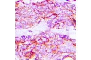 Immunohistochemical analysis of VEGFR2 (pY1214) staining in human breast cancer formalin fixed paraffin embedded tissue section. (VEGFR2/CD309 Antikörper  (C-Term, pTyr1214))