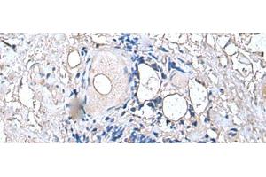 Immunohistochemistry of paraffin-embedded Human thyroid cancer tissue using PTP4A1 Polyclonal Antibody at dilution of 1:45(x200) (PTP4A1 Antikörper)