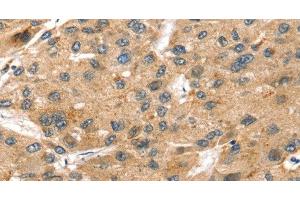 Immunohistochemistry of paraffin-embedded Human liver cancer using SORT1 Polyclonal Antibody at dilution of 1:35 (Sortilin 1 Antikörper)