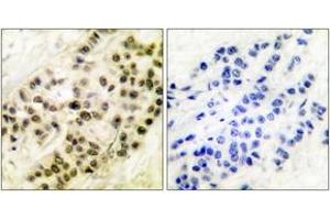 Immunohistochemistry analysis of paraffin-embedded human breast carcinoma tissue, using Cyclin B1 (Ab-126) Antibody. (Cyclin B1 Antikörper  (AA 91-140))