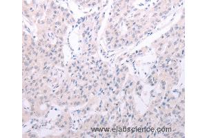 Immunohistochemistry of Human lung cancer using SPATA6 Polyclonal Antibody at dilution of 1:40 (SPATA6 Antikörper)