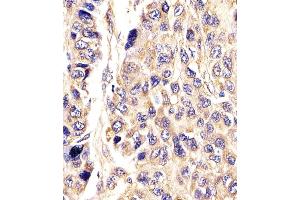 Antibody staining AGXT in Human hepatic carcinoma tissue sections by Immunohistochemistry (IHC-P - paraformaldehyde-fixed, paraffin-embedded sections). (AGXT Antikörper  (AA 96-125))