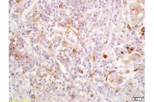 Formalin-fixed and paraffin embedded human lung carcinoma labeled with Anti-EDG1/CD363/S1P1 Polyclonal Antibody, Unconjugated  at 1:200 followed by conjugation to the secondary antibody and DAB staining. (S1PR1 Antikörper  (AA 51-150))