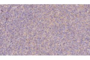 ABIN6273067 at 1/100 staining Human lymph cancer tissue by IHC-P.