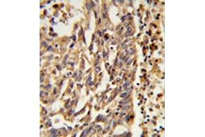 Formalin-fixed and paraffin-embedded human lung carcinoma reacted with KIF11 Antibody (N-term) followed which was peroxidase-conjugated to the secondary antibody, followed by DAB staining. (KIF11 Antikörper  (N-Term))