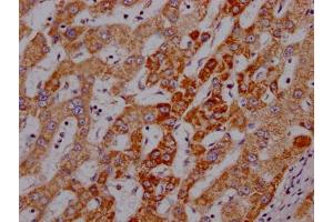 IHC image of ABIN7127339 diluted at 1:100 and staining in paraffin-embedded human liver cancer performed on a Leica BondTM system. (Rekombinanter Angiopoietin 2 Antikörper)