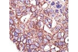 IHC analysis of FFPE human breast carcinoma tissue stained with the SYVN1 antibody (SYVN1 Antikörper  (AA 586-617))