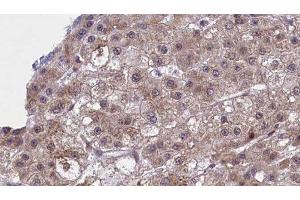 ABIN6277451 at 1/100 staining Human liver cancer tissue by IHC-P. (SLC22A8 Antikörper  (N-Term))