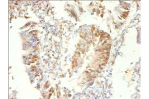 Immunohistochemistry of paraffin-embedded human colon cancer using ABIN7164919 at dilution of 1:100 (PSME3 Antikörper  (AA 2-252))