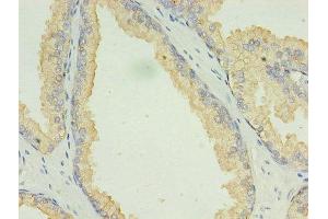 Immunohistochemistry of paraffin-embedded human prostate cancer using ABIN7158804 at dilution of 1:100 (LAMP2 Antikörper  (AA 54-268))