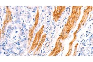 Immunohistochemistry of paraffin-embedded Human gastric cancer using TPM1 Polyclonal Antibody at dilution of 1:40 (Tropomyosin Antikörper)