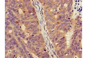 Immunohistochemistry of paraffin-embedded human colon cancer using ABIN7160758 at dilution of 1:100 (FPR3 Antikörper  (AA 307-353))