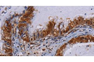 Immunohistochemistry of paraffin-embedded Human esophagus cancer using MECP2 Polyclonal Antibody at dilution of 1:60 (MECP2 Antikörper)