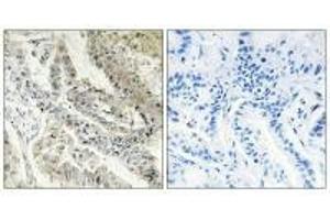 Immunohistochemistry analysis of paraffin-embedded human lung carcinoma tissue, using CRBP III antibody. (Retinol Binding Protein 5 Antikörper)