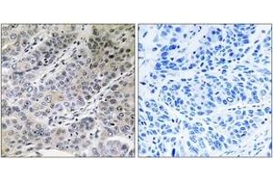 Immunohistochemistry analysis of paraffin-embedded human lung carcinoma tissue, using BRP44 Antibody. (BRP44 Antikörper  (AA 31-80))