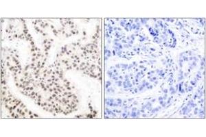 Immunohistochemistry analysis of paraffin-embedded human breast carcinoma, using Elk1 (Phospho-Thr417) Antibody. (ELK1 Antikörper  (pThr417))
