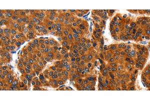 Immunohistochemistry of paraffin-embedded Human liver cancer using HSP75 Polyclonal Antibody at dilution of 1:100 (TRAP1 Antikörper)
