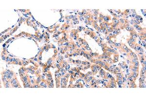 Immunohistochemistry of paraffin-embedded Human thyroid cancer tissue using GRK2 Polyclonal Antibody at dilution 1:87 (GRK2 Antikörper)