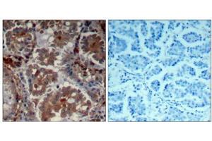 Immunohistochemical analysis of paraffin-embedded human Lung carcinoma tissue using mTOR (Ab-2448) Antibody (E021214). (MTOR Antikörper)