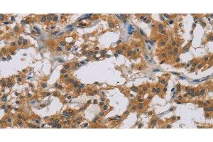 Immunohistochemistry of paraffin-embedded Human thyroid cancer tissue using IL18R1 Polyclonal Antibody at dilution 1:40 (IL18R1 Antikörper)