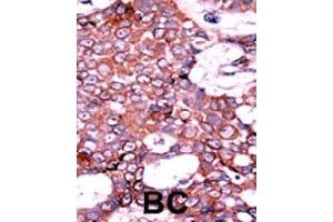 Formalin-fixed and paraffin-embedded human cancer tissue reacted with CDC25A (phospho S75) polyclonal antibody  which was peroxidase-conjugated to the secondary antibody followed by AEC staining.