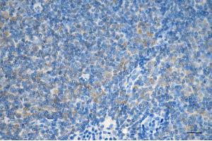 Immunohistochemistry was performed on paraffin-embedded human lymphoma using LC3B antibody (ABIN7799410), 1:200). (Rekombinanter LC3B Antikörper)