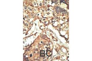 Formalin-fixed and paraffin-embedded human cancer tissue reacted with the primary antibody, which was peroxidase-conjugated to the secondary antibody, followed by AEC staining. (PRKDC Antikörper  (C-Term))