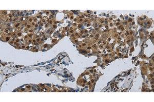 Immunohistochemistry of paraffin-embedded Human breast cancer using PRKAR1B Polyclonal Antibody at dilution of 1:70 (PRKAR1B Antikörper)